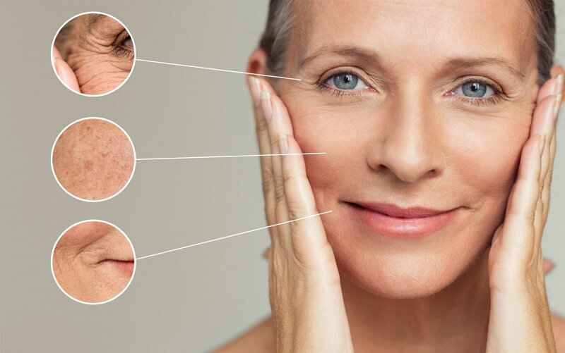 Botox Xóa Nhăn - Liệu Pháp Hồi Phục "Tuổi Trẻ" Của Làn Da 7 Botox cải thiện nếp nhăn mắt (Nguồn: Internet)