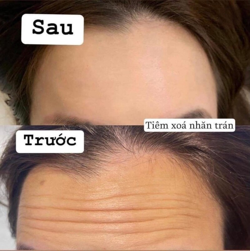 Botox Xóa Nhăn - Liệu Pháp Hồi Phục "Tuổi Trẻ" Của Làn Da 8 Tiêm botox xóa nhăn (Nguồn: Internet)