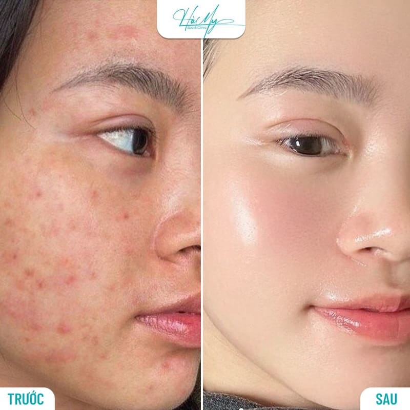 Điều trị mụn Hà Tĩnh, Uy Tín, Chất Lượng và An Toàn 3 Nên điều trị mụn bằng phương pháp chuẩn y khoa để đảm bảo an toàn và hiệu quả cao (Nguồn: Hamy Spa)