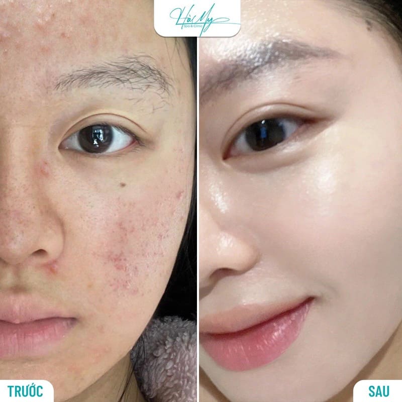 Điều trị mụn Hà Tĩnh, Uy Tín, Chất Lượng và An Toàn 4 Sở hữu da mặt hết mụn và tươi tắn rạng ngời (Nguồn: Hamy Spa)