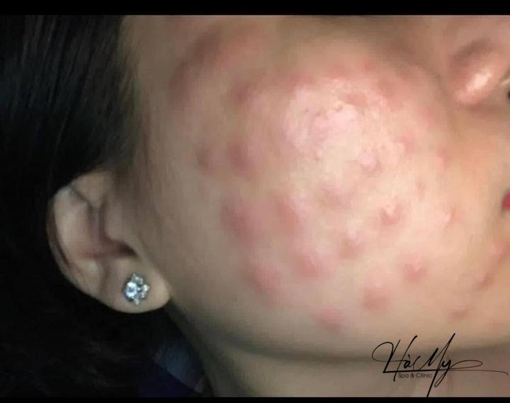 Cấy Meso Căng Bóng: Phương pháp làm đẹp da hiệu quả. 4 Hậu quá trình cấy Meso căng bóng (Nguồn:HaMySpa)