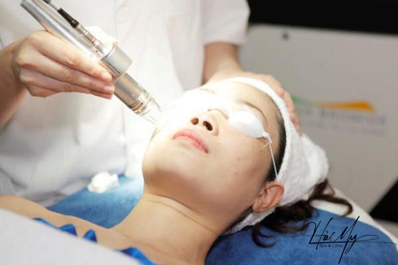 Chăm sóc da sau laser trị nám – Điều trị nám chân sâu bằng laser 4 Quá trình laser điều trị nám (Nguồn:Internet)