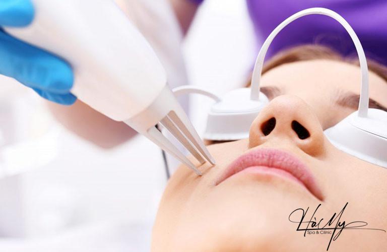 Trị nám bằng laser có hết không? Các phương pháp hiệu quả 5 Quá trình trị nám bằng laser (Nguồn:Internet)