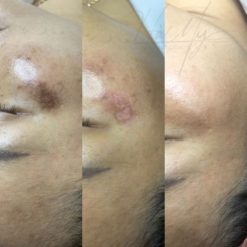 Điều Trị Nám Hà Tĩnh Tận Gốc - Trị Nám Hiệu Qủa 7 Nám da có bị lan không, có hết không là thắc mắc của rất nhiều người bị (Nguồn: Hamy Spa)