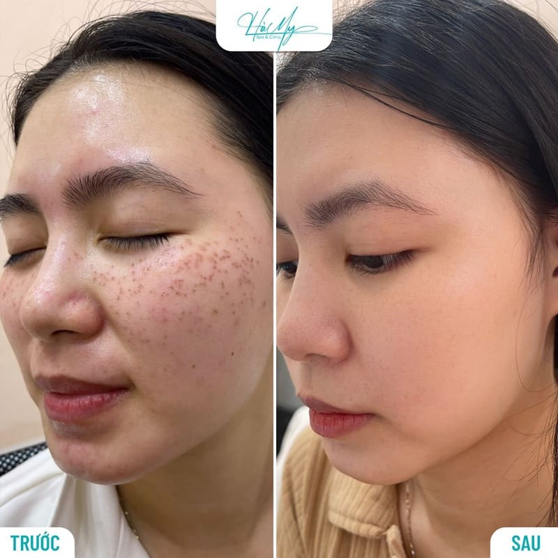 Điều Trị Nám Hà Tĩnh Tận Gốc - Trị Nám Hiệu Qủa 8 Trị dứt điểm tàn nhang - dứt điểm mọi loại dám da (Nguồn: Hamy Spa)