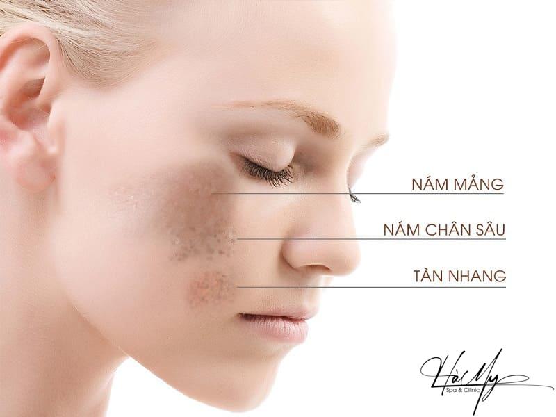 Liệu Trình Trị Nám - Cải Thiện Làn Da Không Tì Vết 4 Nám da và tàn nhang nếu biết cách phân biệt bạn sẽ thấy chúng khác nhau (Nguồn: Internet)