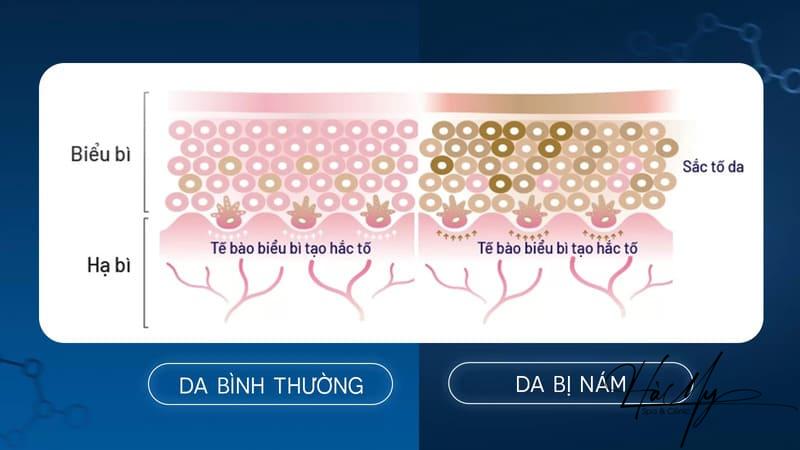Liệu Trình Trị Nám - Cải Thiện Làn Da Không Tì Vết 5 Nám cần được xóa sạch từ dưới sâu bề mặt biểu bì da (Nguồn: Internet)