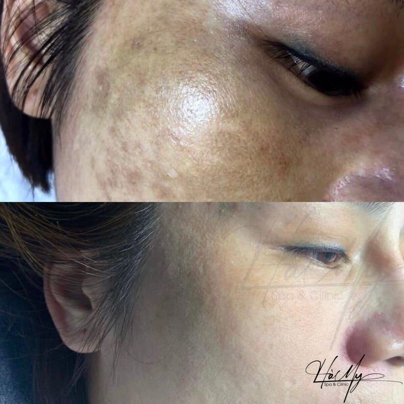 Liệu Trình Trị Nám - Cải Thiện Làn Da Không Tì Vết 6 Da trắng hồng, hết nám sau khi trị tại Hamy Spa (Nguồn: Hamy Spa & Clinic)