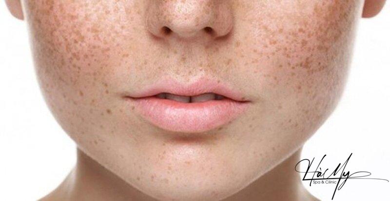 Cách Điều Trị Nám Nội Tiết Giúp Bạn Phục Hồi Làn Da Trắng Sáng 5 Nám nội tiết (Nguồn: Internet)