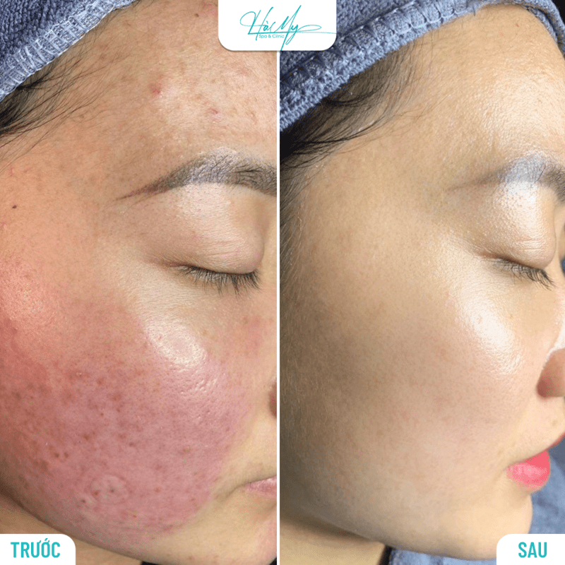 Dịch Vụ Peel Da Hà Tĩnh Uy Tín 8 Khách thực hiện Peel da thành công tại Hamy Spa (Nguồn: Hamy Spa)