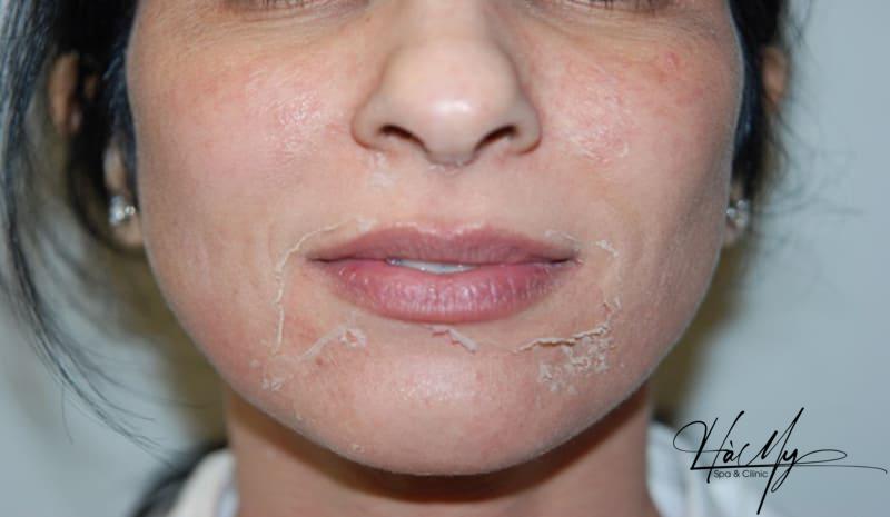 Có Nên Peel Da Tại Spa Hay Không? Địa Chỉ Peel Da Uy Tín 10 Peel da giúp lấy lớp da hư tổn, lộ ra lớp da mới tươi trẻ và khỏe mạnh hơn (Nguồn: Internet)