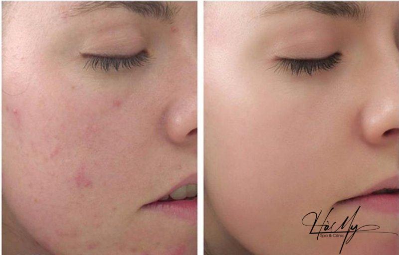 Có nên rửa mặt sau khi peel da không? 6 Thực hiện phương pháp đúng cách giúp da mặt luôn tươi trẻ (Nguồn:Internet)
