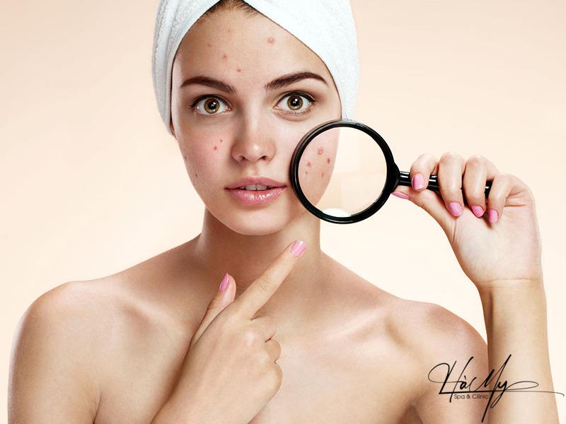 Tiêm Meso Trị Mụn - Giải Pháp Lý Tưởng Cho Tất Cả Các Loại Da 6 Mụn có thể ảnh hưởng đến tâm lý của bạn (Nguồn: Internet)