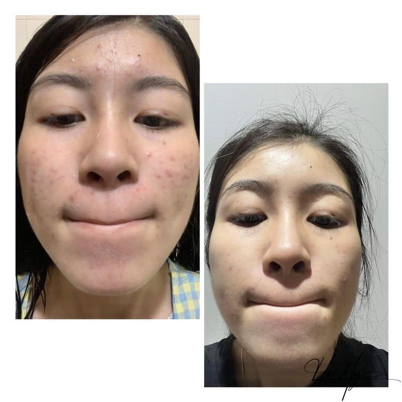 Tiêm Meso Trị Mụn - Giải Pháp Lý Tưởng Cho Tất Cả Các Loại Da 8 Tiêm meso trị mụn là một trong những phương pháp thẩm mỹ được ưa chuộng hiện nay (Nguồn: Hamy Spa)