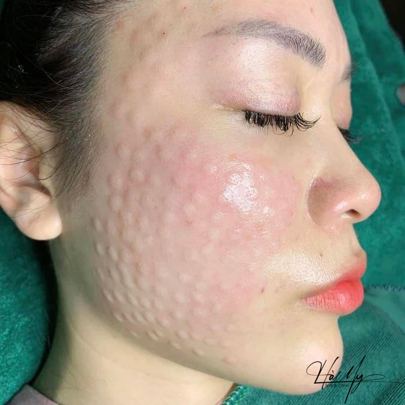 Tiêm Meso Trị Mụn - Giải Pháp Lý Tưởng Cho Tất Cả Các Loại Da 9 Tiêm meso với các chất đưa trực tiếp vào da (Nguồn: Internet)