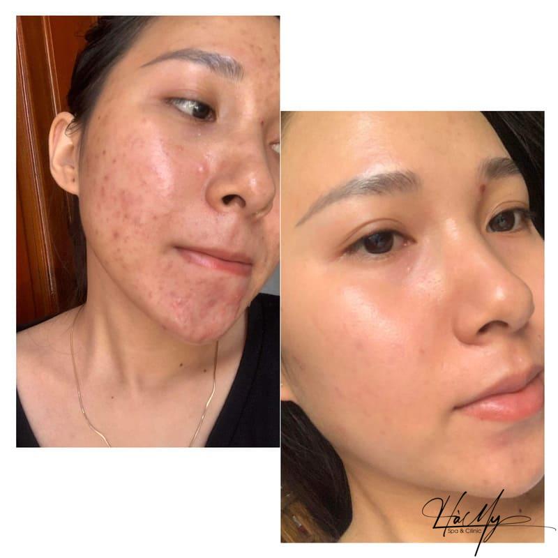 Tiêm Meso Trị Mụn - Giải Pháp Lý Tưởng Cho Tất Cả Các Loại Da 10 Hiệu quả tiêm Meso trị mụn (Nguồn: Hamy Spa)
