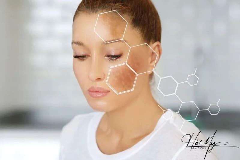 Tiêm Meso Trị Nám - Độ Hiệu Quả Và Đáng Tin Cậy Cho Làn Da Mượt Mà Và Sáng Bóng 5 Tiêm meso trị nám làm giảm hình thành đốm nâu làm tối màu da (Nguồn: Internet)