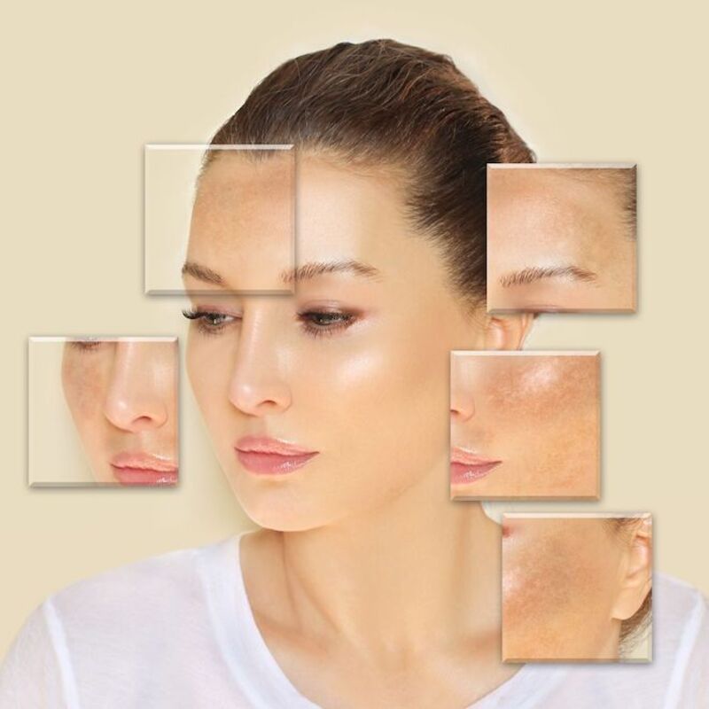 Tiêm Meso Trị Nám - Độ Hiệu Quả Và Đáng Tin Cậy Cho Làn Da Mượt Mà Và Sáng Bóng 6 Tiêm meso phù hợp cho mọi chị em đang bị nám, sạm, tàn nhang (Nguồn: Internet)