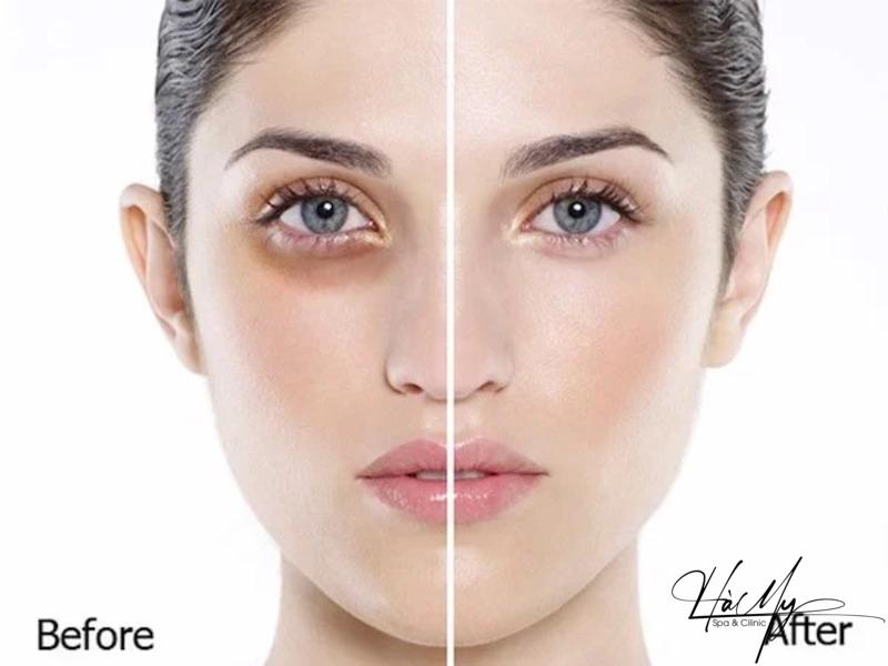 Tiêm Meso Trị Thâm Mắt - Giải Quyết Vấn Đề Thâm Mắt Hiệu Quả 7 Hiệu quả tiêm mose trị thâm mắt (Nguồn: Internet )