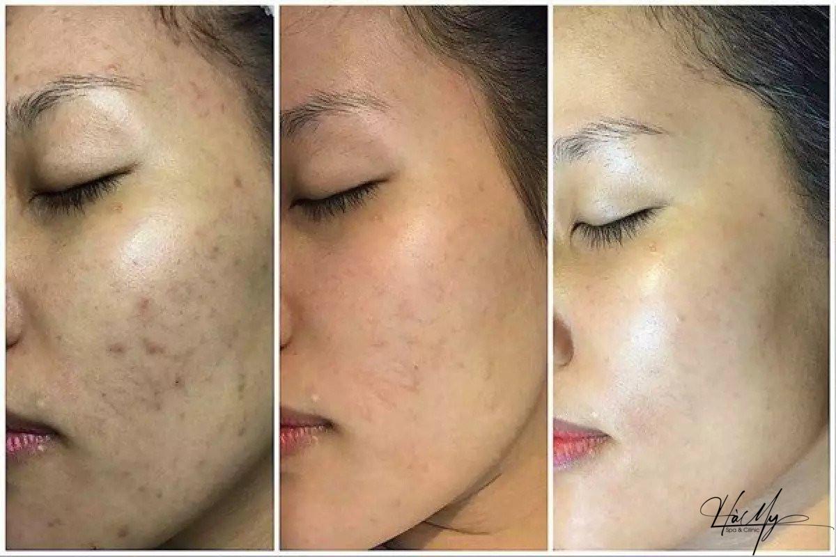 Tác dụng của Peel da và cách sử dụng Peel Da hiệu quả 6 Kết quả sau một thời gian dùng peel da (Nguồn:Internet)