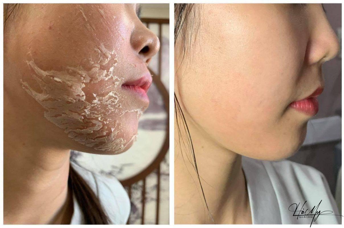 Tác dụng của Peel da và cách sử dụng Peel Da hiệu quả 8 Làn da tươi mịn sau liệu trình (Nguồn:Internet)
