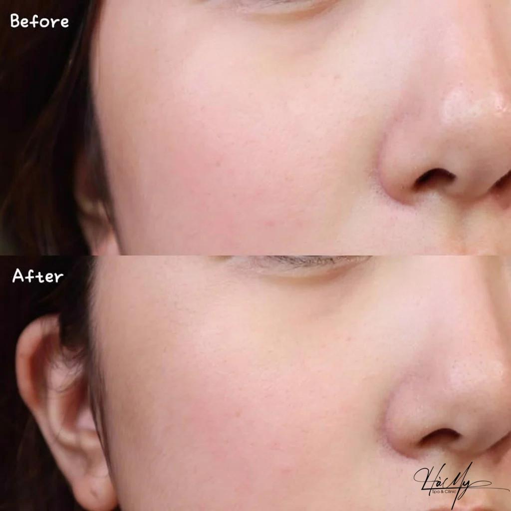 Peel da vi tảo Retinol Le Peau có tốt không? 6 Trước và sau khi dùng peel da vi tảo (Nguồn:Internet)