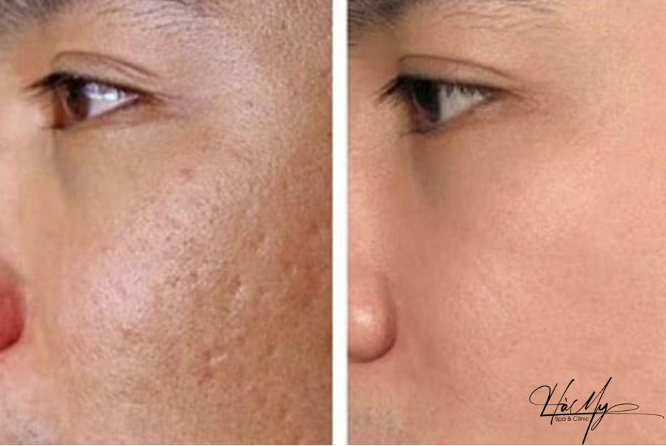 Peel da có trị sẹo rỗ được không? Hiệu quả của TCA peel trong việc trị sẹo rỗ 4 Khách hàng sau một thời gian dùng TCA (Nguồn:Internet)