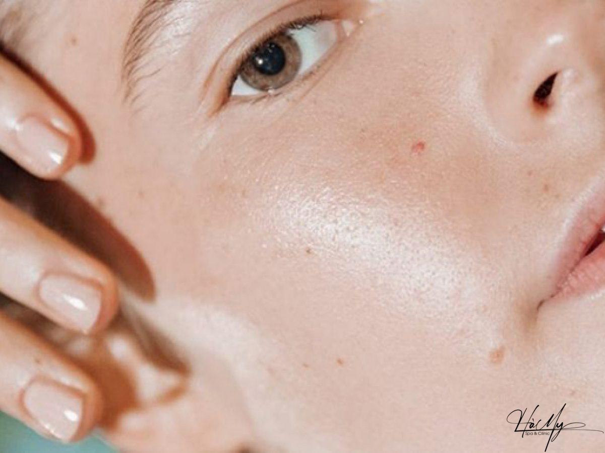 Peel da có đẩy mụn không? Tìm hiểu về hiệu quả và tác động của peel da đối với mụn 5 Peel da có đẩy mụn không (Nguồn:Internet)