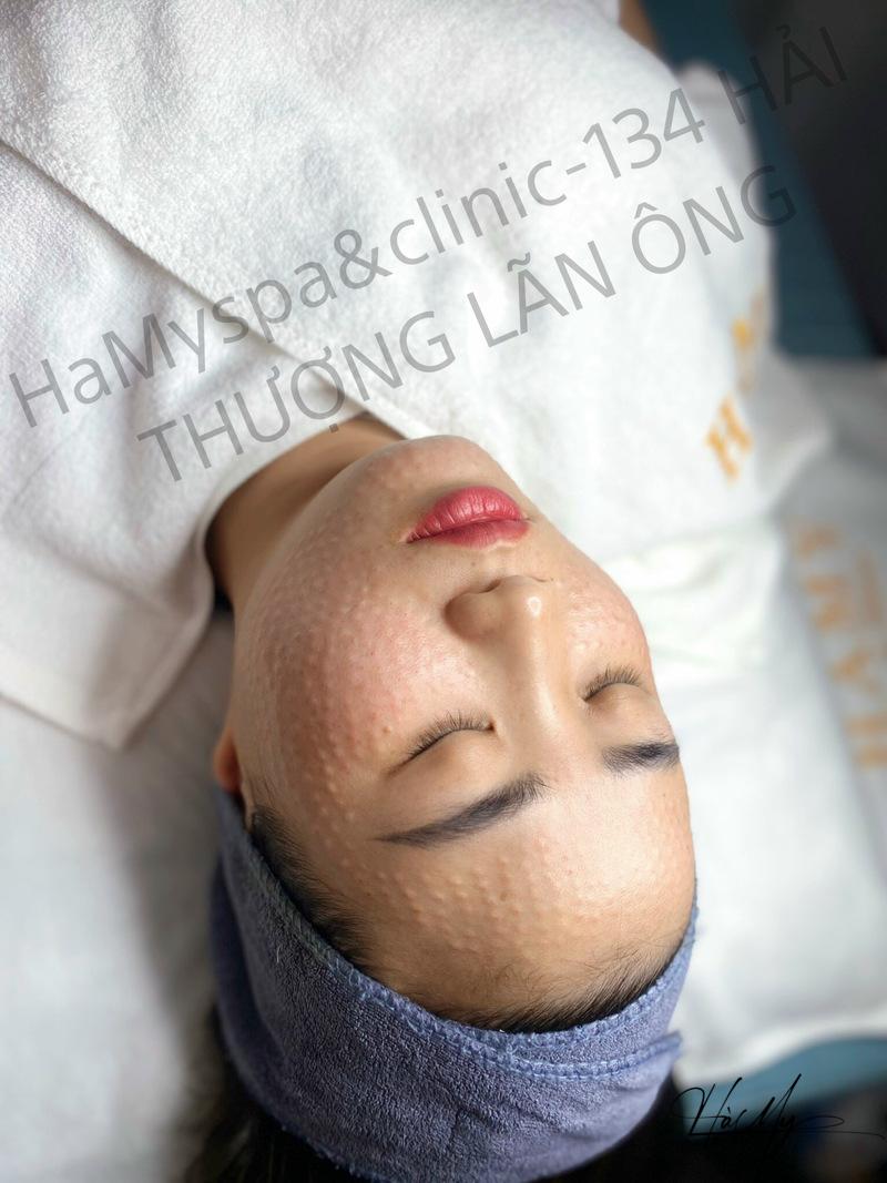 Kỹ Thuật Tiêm Mesotherapy Cách Để Da Mặt Đẹp - An Toàn 8 Kỹ thuật tiêm mesotherapy – “phép thần” đưa da trở về tuổi thanh xuân (Nguồn: Hamy Spa)