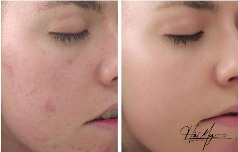 Peel Da Hóa Học Là Gì: Những Điều Cần Biết Về Tác Dụng - Rủi Ro 6 Peel da hoá học hiệu quả trong việc cải thiện vẻ ngoài (Nguồn: Internet)