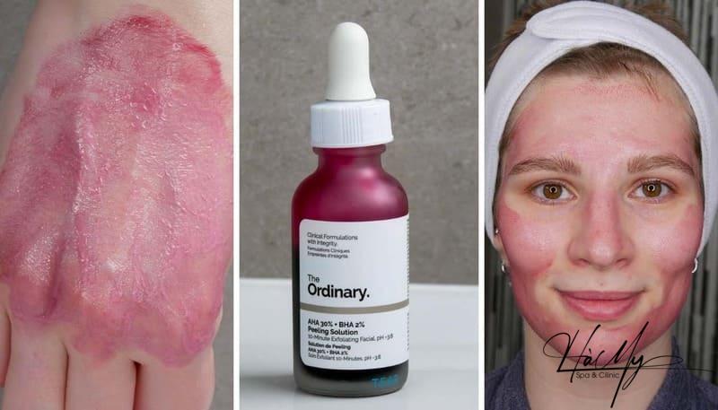 Peel Da Ordinary Có Tốt Không? Những Điều Bạn Cần Biết 9 Mới đầu sử dụng peel da The Ordinary sẽ có cảm giác châm chích (Nguồn: Internet)