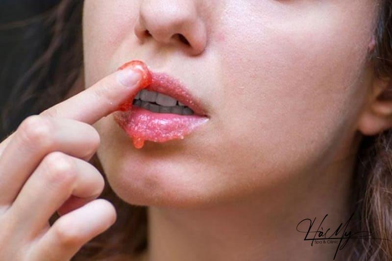 Phun Môi Bị Chảy Nước Mô - Nguyên Nhân Và Cách Khắc Phục 8 Cần vệ sinh môi kỹ lưỡng hàng ngày với nước muối sinh lý (Nguồn: Internet)