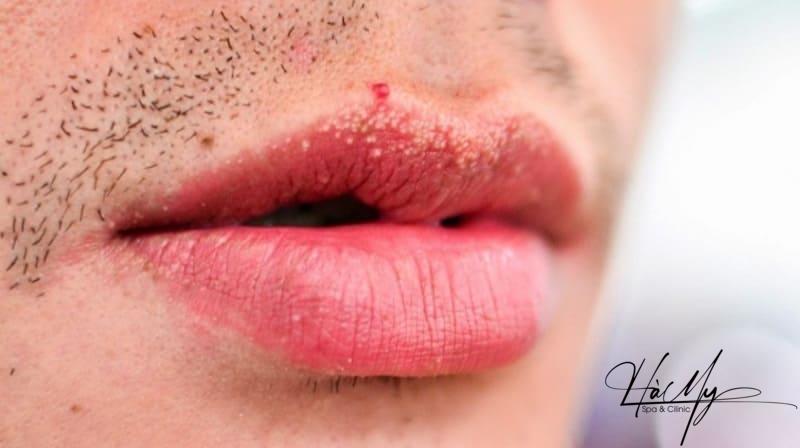 Phun Môi Bị Mụn Nước Có Để Lại Sẹo Không? Cách Khắc Phục 7 Hiện tượng nổi mụn nước ở môi sau khi phun môi (Nguồn: Internet)