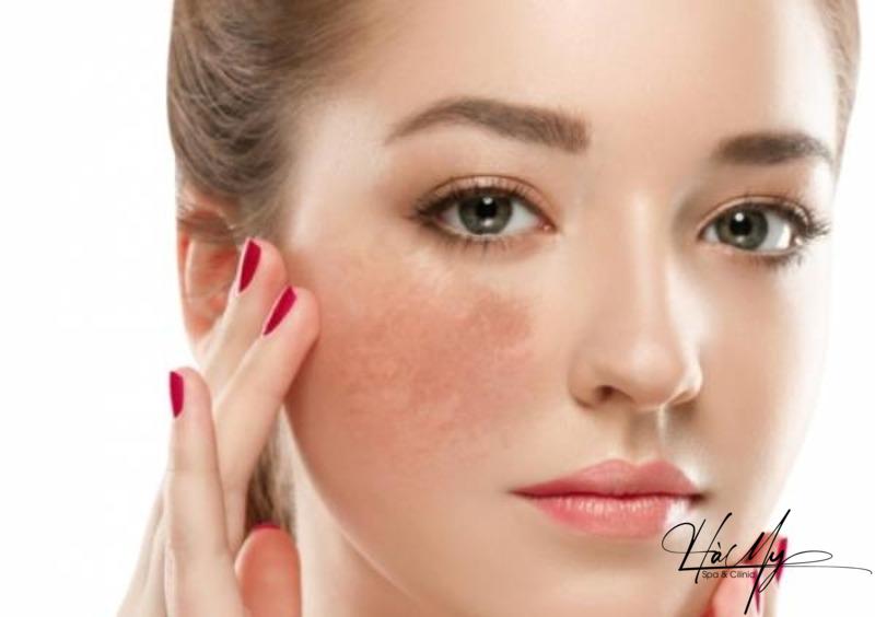 Các phương pháp trị nám tại spa và những lợi ích cho da 7 Các phương pháp trị nám tại spa (Nguồn: Internet)