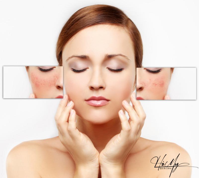 Các phương pháp trị nám tại spa và những lợi ích cho da 8 Nám, tàn nhang là biểu hiện của các hắc tố xuất hiện trên bề mặt da (Nguồn: Internet)