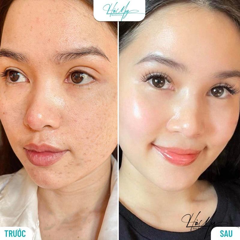 Các phương pháp trị nám tại spa và những lợi ích cho da 10 Trước và sau điều trị nám tại Hà My Spa (Nguồn: Hà My Spa)