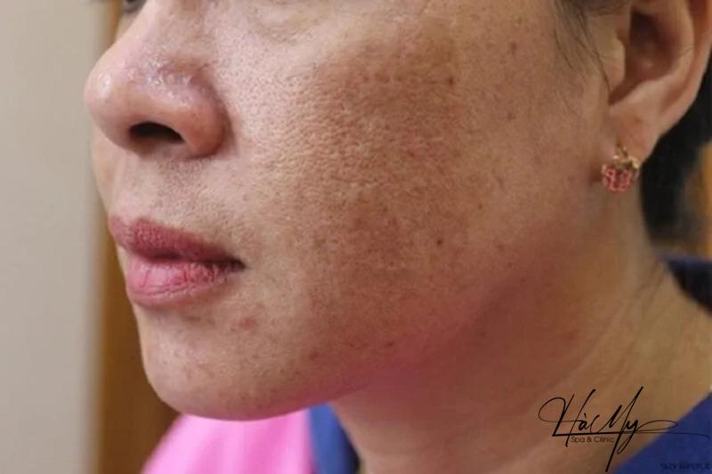 Cách trị nám mảng hiệu quả mà bạn nên biết 6 Dấu hiệu nhận biết khi xuất hiện tình trạng nám mảng trên da (Nguồn: Internet)