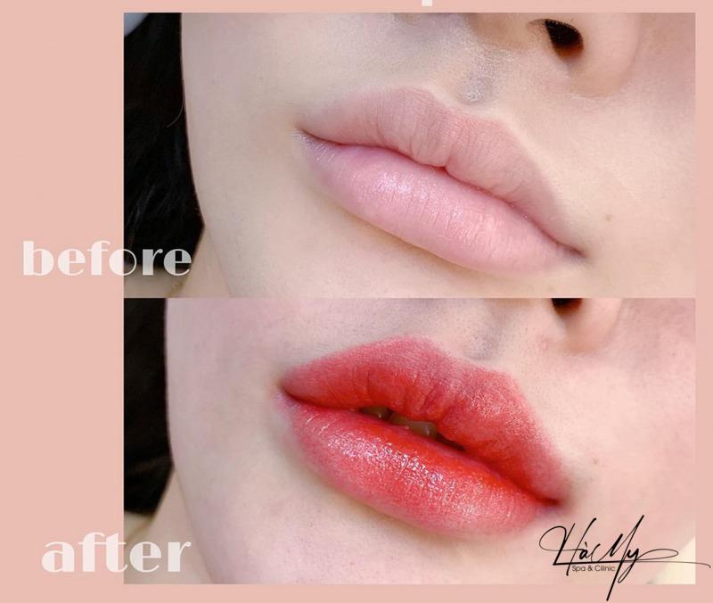 Có nên phun môi collagen không? 5 ưu điểm nổi bật 8 Sắc môi thâm xỉn trở nên hồng hào, tươi tắn và mềm hơn trông thấy (Nguồn: Internet)