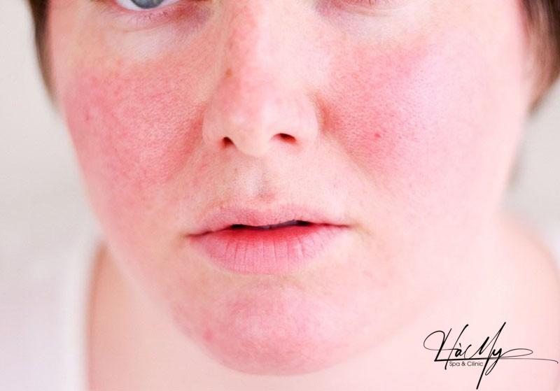 Da mỏng có nên peel da? Cách chăm sóc da mỏng yếu sau peel 6 Da mỏng có nên peel da? (Nguồn: Internet)