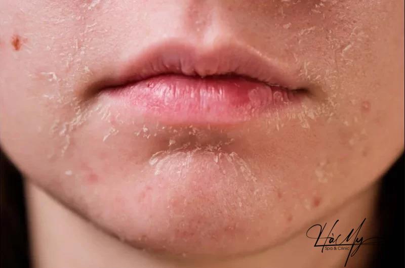 Da mỏng có nên peel da? Cách chăm sóc da mỏng yếu sau peel 9 Sau peel da sẽ xuất hiện tình trạng da ửng đỏ (Nguồn: Internet)