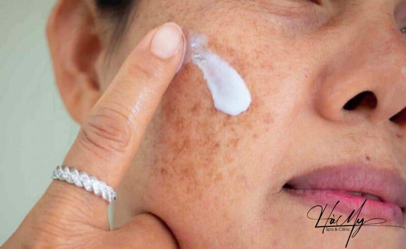 Chia sẻ kinh nghiệm trị nám chân sâu dứt điểm nhanh chóng 5 Nám chân sâu là gì? Nám chân sâu là nám ở lớp bì của da (Nguồn: Internet)