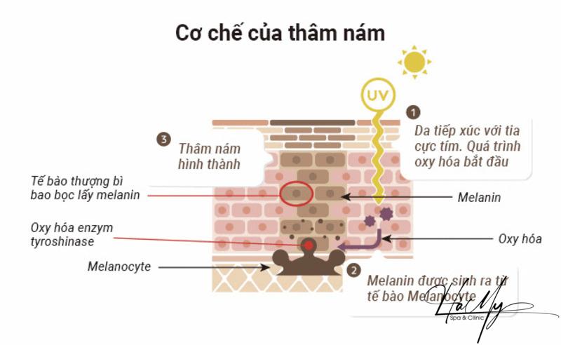 Nám Chân Đinh: Nguyên Nhân Hình Thành Và Cách Điều Trị Hiệu Quả Nhất 6 Sự hình thành nám da (Nguồn: Internet)