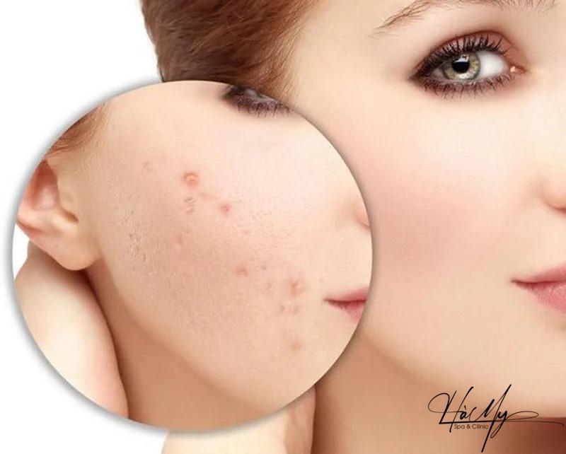 Phương pháp peel da có trị thâm không? Sự thật bạn cần biết 6 Peel da trị thâm loại bỏ thâm mụn và lấy lại làn da mịn màng (Nguồn: Internet)