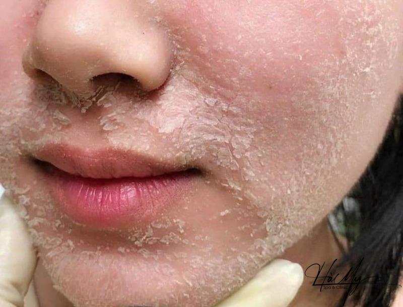 Phương pháp peel da có trị thâm không? Sự thật bạn cần biết 7 Phương pháp peel da có trị thâm không? (Nguồn: Internet)