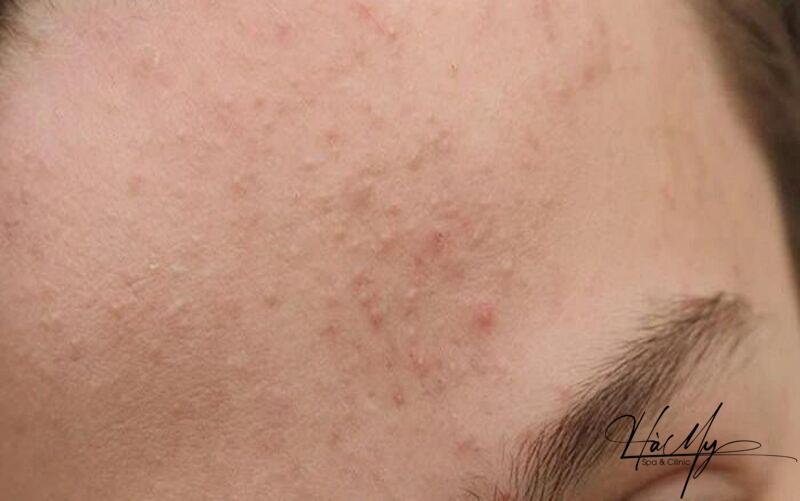 Peel da trị mụn ẩn có hết không? Sự thật đằng sau là gì? 5 Peel da trị mụn là một trong những phương pháp trị mụn ẩn, mụn cám, mụn đầu đen,... hiệu quả (Nguồn: Internet)