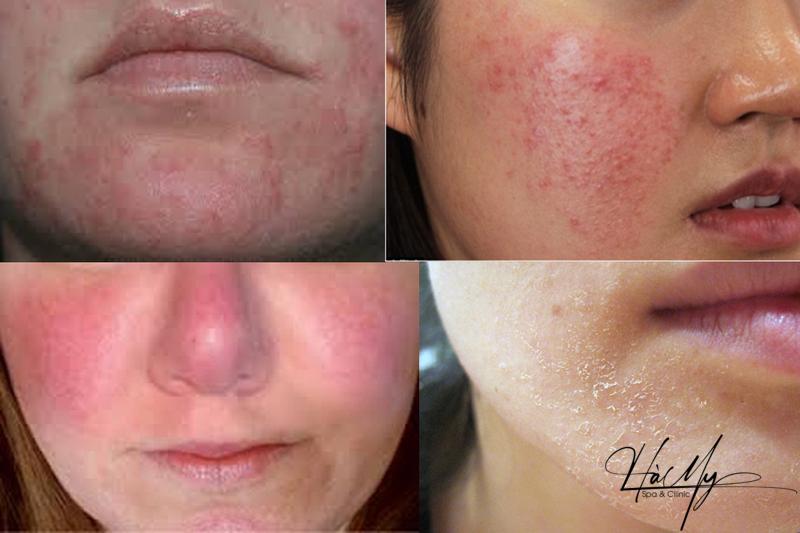 Peel da xong bị đỏ và các hiện tượng thường gặp sau Peel 5 Bạn cần biết cách phân biệt tác dụng phụ và biến chứng sau khi Peel (Nguồn: Internet)