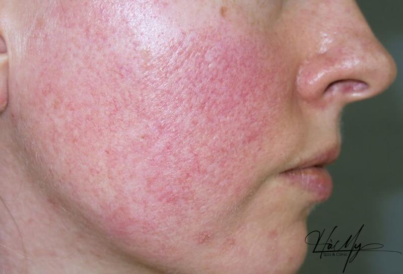 Peel da xong bị đỏ và các hiện tượng thường gặp sau Peel 6 Một số hiện tượng sau khi peel da thường gặp (Nguồn: Internet)