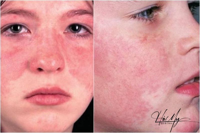 Peel da xong bị đỏ và các hiện tượng thường gặp sau Peel 7 Biến chứng Peel da xong bị đỏ (Nguồn: Internet)