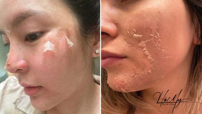 Sau khi peel da xong có dùng niacinamide được không? Điều cần lưu ý 5 Công dụng “thần thánh” của niacinamide trong routine chăm sóc làn da (Nguồn: Internet)