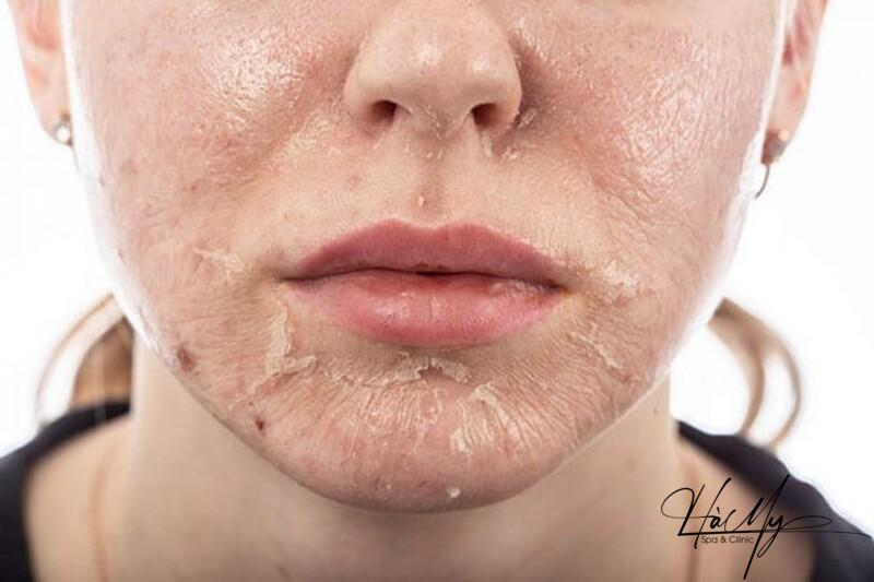 Sau khi peel da xong có dùng niacinamide được không? Điều cần lưu ý 7 Nên dùng niacinamide sau khi peel da xuất hiện tình trạng lão hóa (Nguồn: Internet)